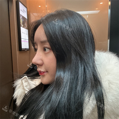 韓國DL整形外科鼻修復(fù)術(shù)后側(cè)面圖