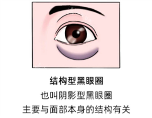 结构型黑眼圈的样子图解