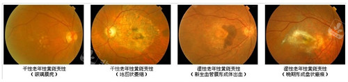 黄斑病变不同的表现