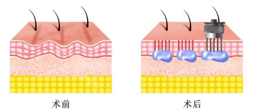 填充针剂改善皮肤皱纹