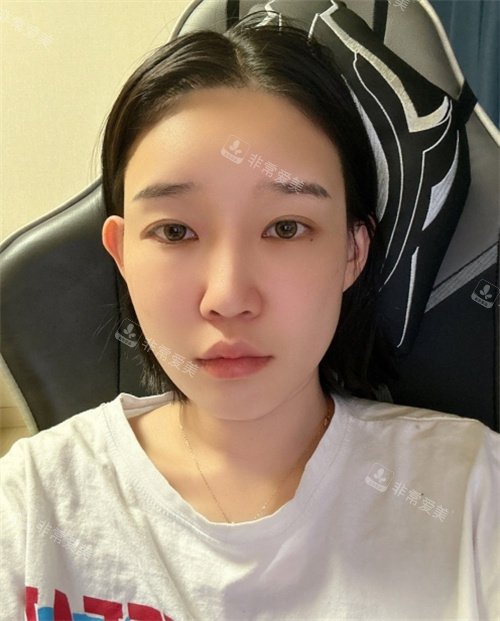韓國DL整形外科真人術(shù)前生活照 韓國DL整形外科真人術(shù)前生活照