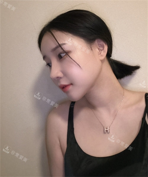 韓國DL整形外科術(shù)后恢復照 韓國DL整形外科術(shù)后恢復照