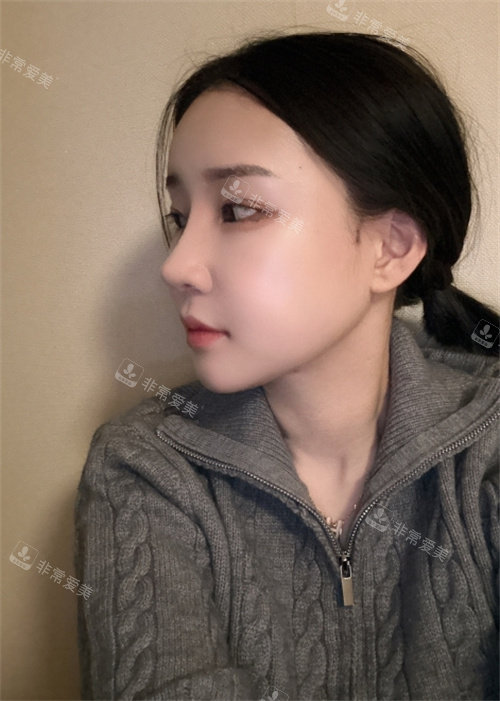 韩国DL整形外科轮廓+鼻子术后照