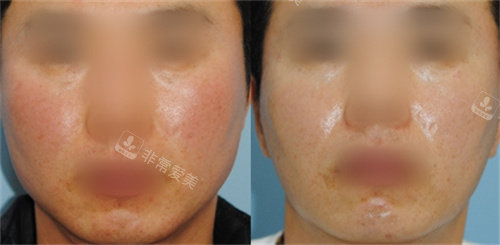 韩国昌皮肤科治疗对比图