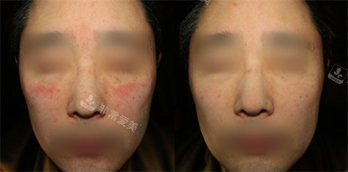 韓國昌皮膚科真人展示 韓國昌皮膚科真人展示