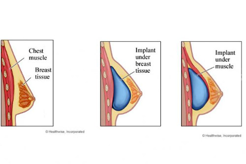 植入假体隆胸后的样子图解