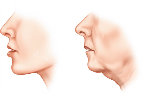 拉皮手术改善下颌皮肤松弛下垂