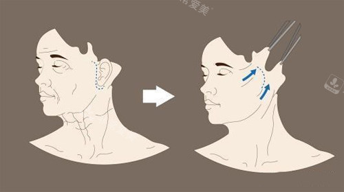 拉皮手術(shù)前后示意圖 拉皮手術(shù)前后示意圖