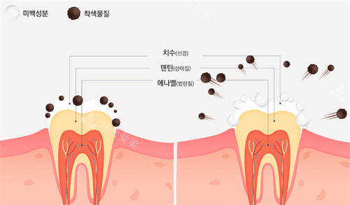 牙齒美白過程圖解