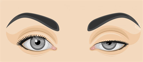 双眼皮动画图