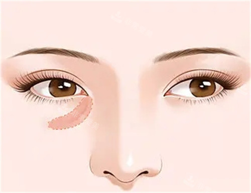 泪沟填充前后对比