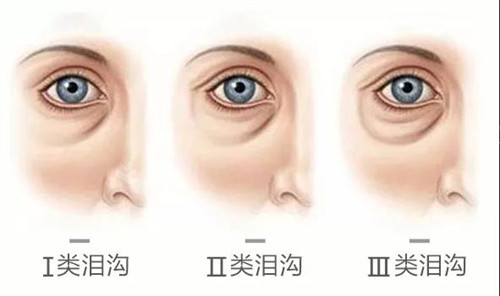泪沟不同程度的表现