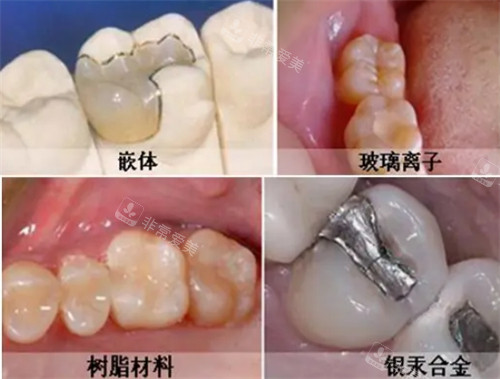 不同材料补牙的区别图解