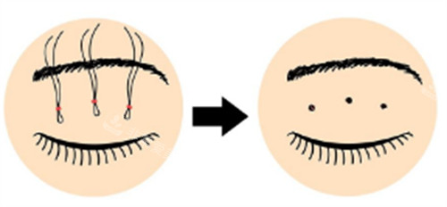 三点式双眼皮操作过程图解