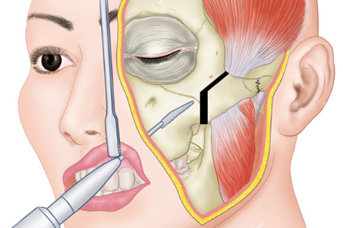 颧骨颧弓整形口腔内切口手术过程图解