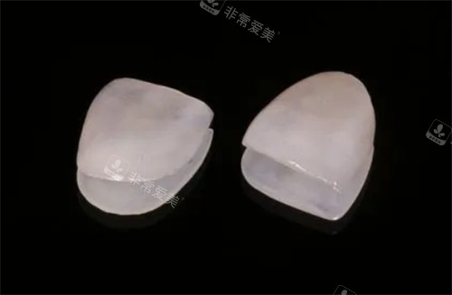 全瓷牙齿贴面的样子图片