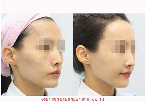 韩国Toxnfill皮肤科三成店面部填充前后对比侧面