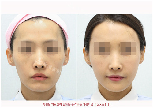 韩国Toxnfill皮肤科三成店面部填充前后对比图正面
