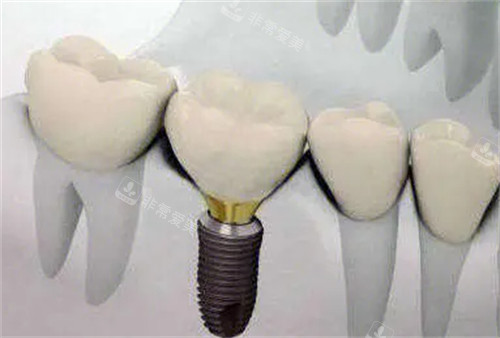 牙齿种植后的样子图解