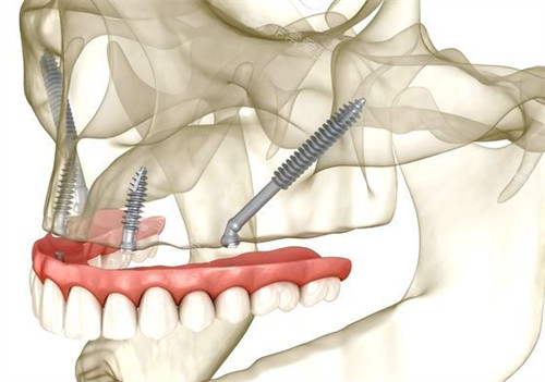 all-on-4高难度种植过程图解