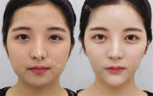 韩国Toxnfill皮肤科三成店瘦脸前后对比照
