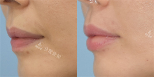 韩国昌皮肤科玻尿酸填充丰唇前后对比图