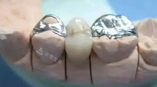 镶牙治疗细节图