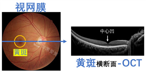 黄斑眼病横切面的样子图解