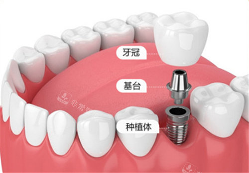 种植牙组成部分展示