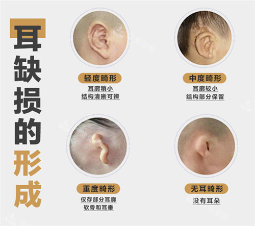 耳朵缺失的不同程度
