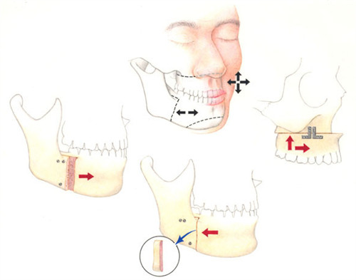 下巴截骨手术流程图