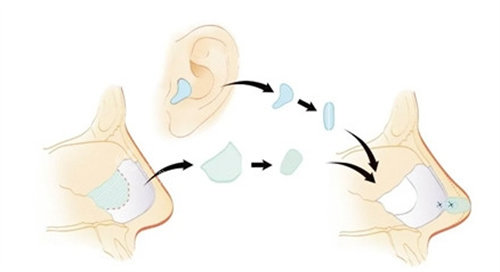耳软骨隆鼻动画图