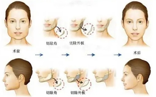 下颌角手术过程图