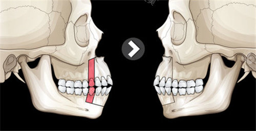正颌手术图示