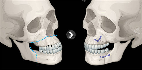 正颌手术动画图