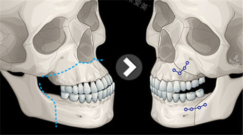 骨性地包天手术整形费用分享,骨性地包天下颌正颌手术多钱?