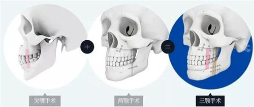 不同正颌术式图