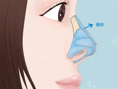 隆鼻动画图