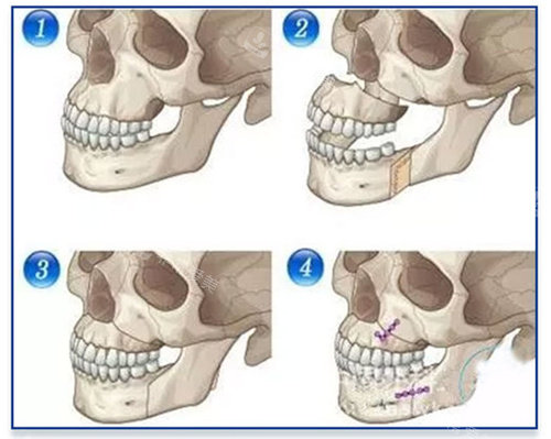 正颌手术过程图