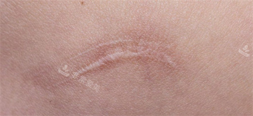 影响皮肤平整度的疤痕