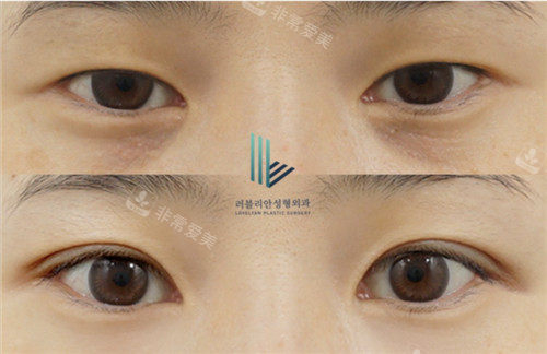 樂于麗顏眼部整形照片