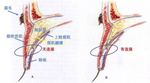 双眼皮结构图