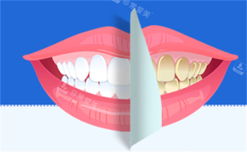牙齿美白前后的样子图片