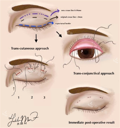 双眼皮手术过程图