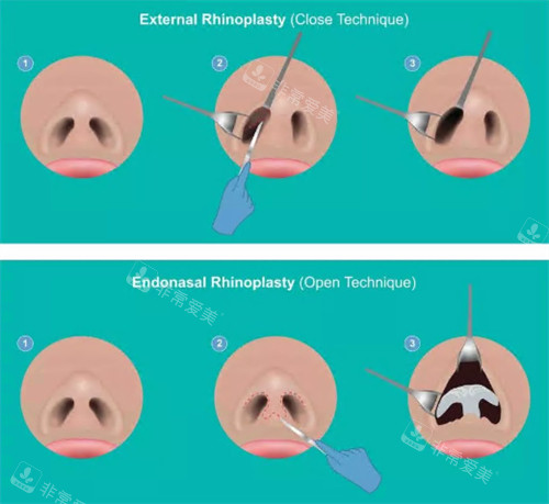 鼻整形过程图