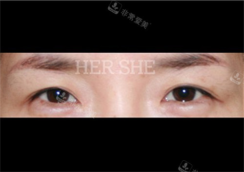 赫爾希整形外科眼部整形術前圖