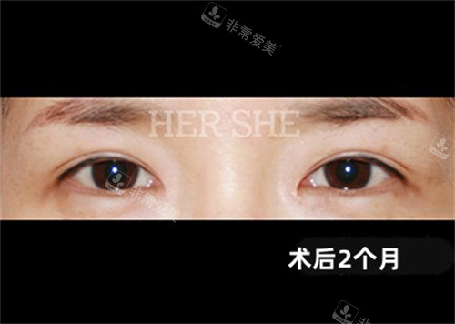 赫爾希整形外科眼部整形術后圖