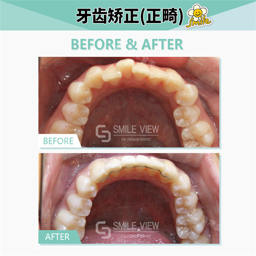 江南SMILE VIEW牙科矯正前后對(duì)比照 江南SMILE VIEW牙科矯正前后對(duì)比照