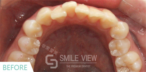 江南SMILE VIEW牙科牙齿矫正前照片