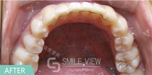 江南SMILE VIEW牙科牙齒矯正后照片